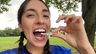 75 month update TMJ Orthotic Splint Therapy [upl. by Edgell]