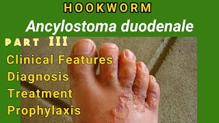 Hookworm  Ancylostomiasis Clinical Features Diagnosis Treatment Prophylaxis  AM Biologie Notes [upl. by Chelsy859]