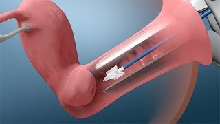 Pap and HPV Testing [upl. by Sergius]