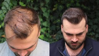 Hair Transplant Result with 3040 Grafts  EXTREME TRANSFORMATION from 0 days to 10 Months [upl. by Demodena]