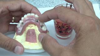 Overdenture Abutment Part 1 [upl. by Torrance]