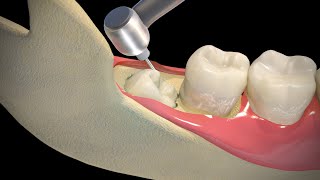 Wisdom Teeth Extraction  Step by step [upl. by Alliuqal781]