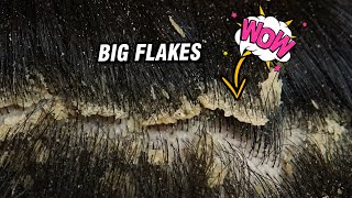 Big Flakes Scratching Satisfying  Dandruff Removal 1267 [upl. by Arvie]