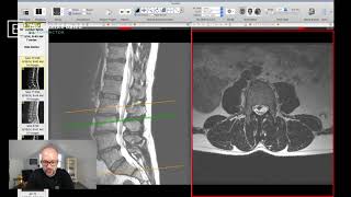 Clinical Series Lumbar Spinal Stenosis on MRI [upl. by Blount]