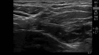 Ultrasound guided Suprascapular nerve block Anterior approach [upl. by Llennahs]