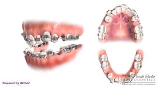 4 Second Bicuspid Extraction  Orthodontic Treatment [upl. by Cissie932]