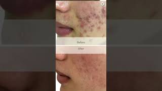 Watch Before amp After Acne Results [upl. by Aicilyt391]