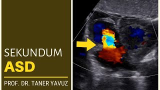 Sekundum ASD  Ekokardiyografi [upl. by Scharff]