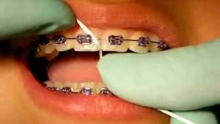 Bracesquestionscom  Flossing With Braces How to Floss Teeth [upl. by Enilorak]