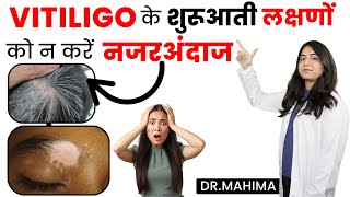 Early Sign amp Symptoms Of Vitiligo in Hindi  सफेद दाग के शुरुआती लक्षण  Dr Mahima [upl. by Aziar46]