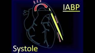 Intraaortic Balloon Pump Aortic Pressure Curve [upl. by Einram]