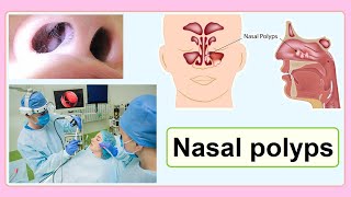 nasal polyps [upl. by Bisset]