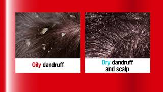 Alpecin Hybrid Caffeine Shampoo  Fight dry dandruff and hair loss [upl. by Gadmon]