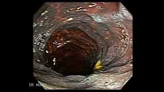 Colonoscopy of Severe Melanosis Coli [upl. by Jenette]