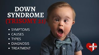 What is Down Syndrome Trisomy 21 Down syndrome Trisomy 21 Made Easy [upl. by Nels]