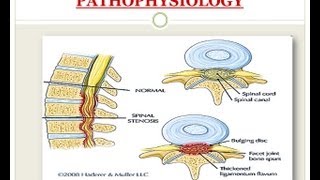 Spinal Stenosis  Medical PowerPoint Presentation [upl. by Ecnerolf263]