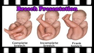 ICD9 Coding Question — 65221 Code amp Breech Birth Explained [upl. by Milford602]