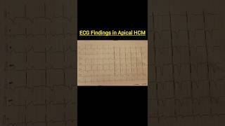 ECG Findings in Apical HCM cardiomyopathyhypertrophyhypertensionheartfailurepericarditisaorta [upl. by Ahseyt]