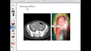 Peritoneum Part 3  General Surgery Course 4th  6th Stages [upl. by Orfield]