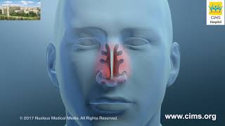 Nasal Turbinate Reduction – CIMS Hospital [upl. by Jami]