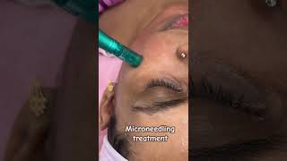 Microneedling needling treatment for skin brighteningskin rejuvenation 😱Skin smile clinic Bhopal [upl. by Teahan]