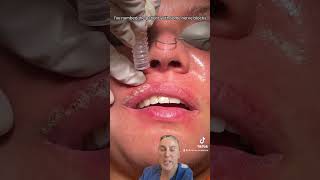 LASE TREATMENT OF FORDYCE SPOT [upl. by Ahsiled]