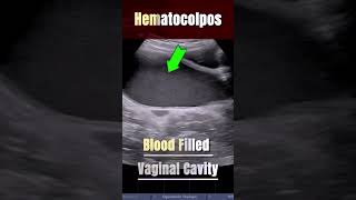 Hematocolpos  13yrs old Girl with Imperforate Hymen ultrasound pain [upl. by Htessil938]