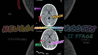 Neurocysticercosis NCC in CT Scan shortshorts ytshorts youtubeshorts radiology medical [upl. by Nirb]