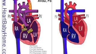 25  Total Anomalous Pulmonary Vein Return TAPVR with DORV AVSD ps [upl. by Meil13]