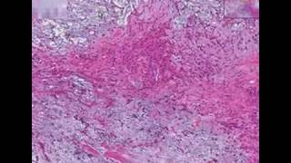 Benign Mixed Tumour of Salivary Gland  Pleomorphic Adenoma Histopathology [upl. by Telford]