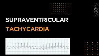 Supraventricular Tachycardia  SVT [upl. by Gleason810]