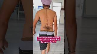 Best scoliosis treatment of severe challenging case by DrRavi scoliosis chiropractic physio ree [upl. by Hesther469]