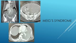 MEIGS SYNDROME [upl. by Robbi]