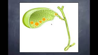 Lithiase Biliaire  1Lithiase biliaire asymptomatique et symptomatique [upl. by Suaeddaht]