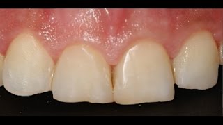 Reconstrucción incisivos superiores con composite estético y estratificación [upl. by Helyn]