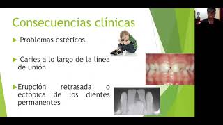 Anomalías dentarias Fusión dental [upl. by Notniv]