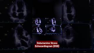 dobutamine stress echocardiogram DSE [upl. by Suirtemid]