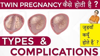 Twins Pregnancy Types Dichorionic Conjoined Monochorionic Diamniotic Monochorionic Monoamniotic [upl. by Nunes]