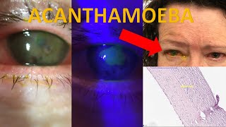 Acanthamoeba keratitis Severe case diagnosis investigation management Evidencebased series [upl. by Llenaj32]