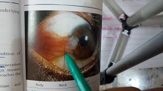 PTERYGIUM verry IMPORTANT conjuctival condition explanation with scenario [upl. by Ytteb]