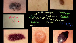 Melanocytic Lesions Part 2 [upl. by Michaeu]