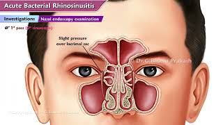 Acute Bacterial Rhinosinusitis ABRS  ENT Lectures [upl. by Alrahc]