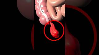 Appendicitis Causes And Symptoms [upl. by Anaerda895]