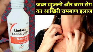 Noscab Lotion  Lindane Lotion How to use benefits in hindi [upl. by Leik]