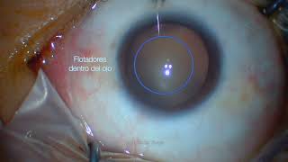 Vitrectomía para remover flotadores  Vitrectomy for floaters  Dr Aureliano Moreno [upl. by Naor]