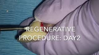 Regenerative Endodontics [upl. by Hgielah]