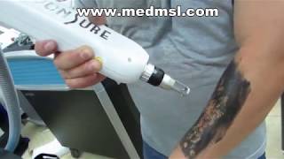 Professional medical picosecond laser tattoo removal device operation [upl. by Ellennej462]