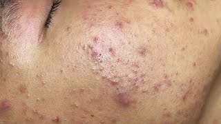 ACNE TREATMENT VU QUYNH MI Blackheads On Boy Face 2024 [upl. by Neelrihs]