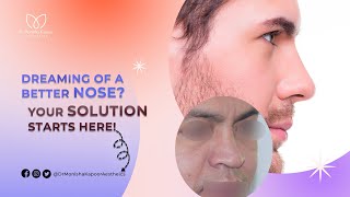 Revision Rhinoplasty Surgery Procedure in Delhi  Nose Surgery Before amp After  Dr Monisha Kapoor [upl. by Bertila]