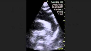 VSCAN Echocardiography The Normal Exam Suprasternal Notch Views [upl. by Aisha]